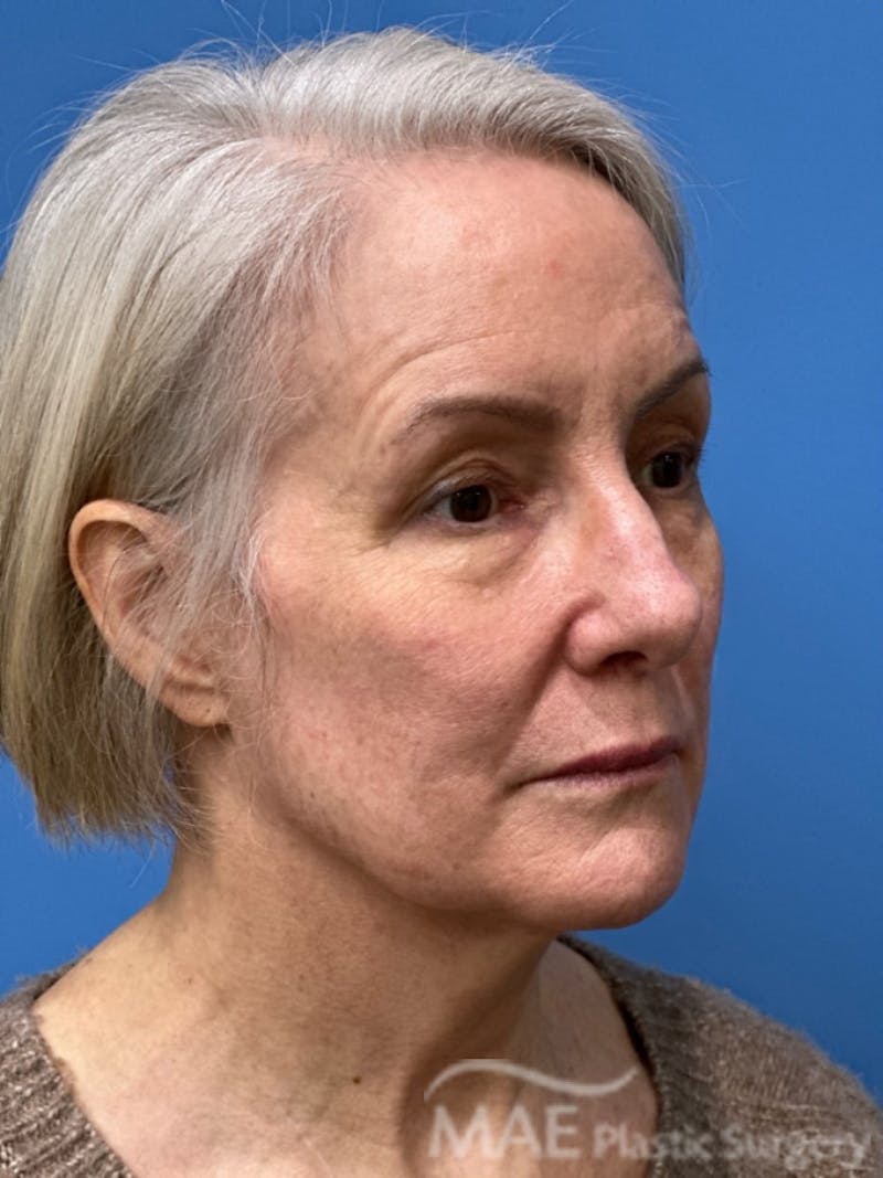 Facelift Before & After Gallery - Patient 278823 - Image 3