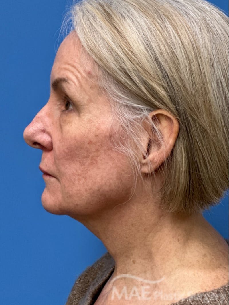 Facelift Before & After Gallery - Patient 278823 - Image 5