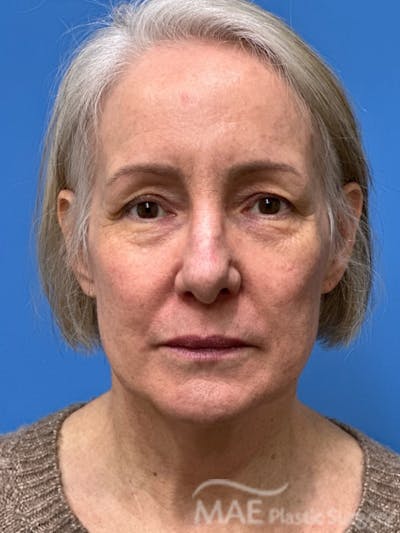 Facelift Before & After Gallery - Patient 278823 - Image 1