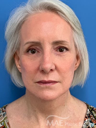 Facelift Before & After Gallery - Patient 278823 - Image 2