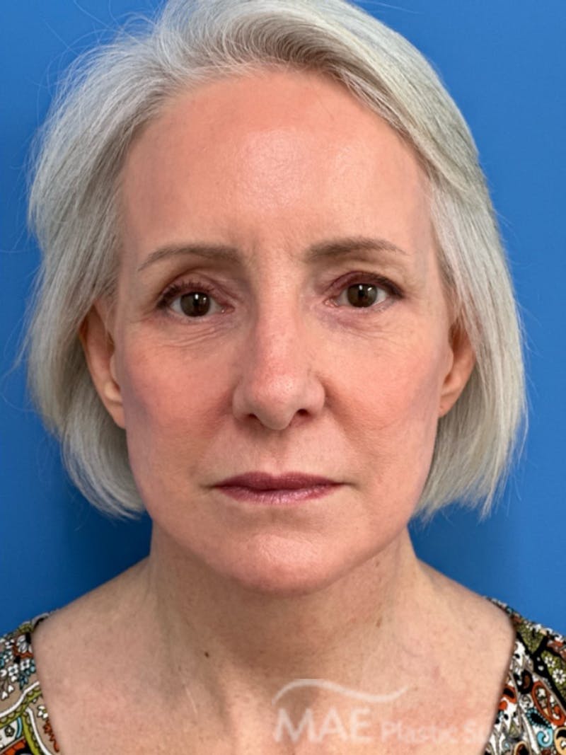 Facelift Before & After Gallery - Patient 278823 - Image 2