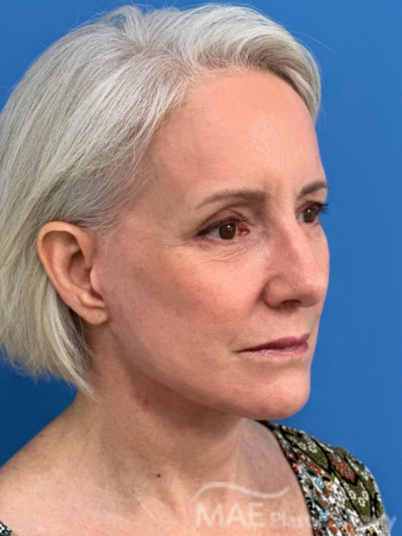 Facelift Before & After Gallery - Patient 278823 - Image 4