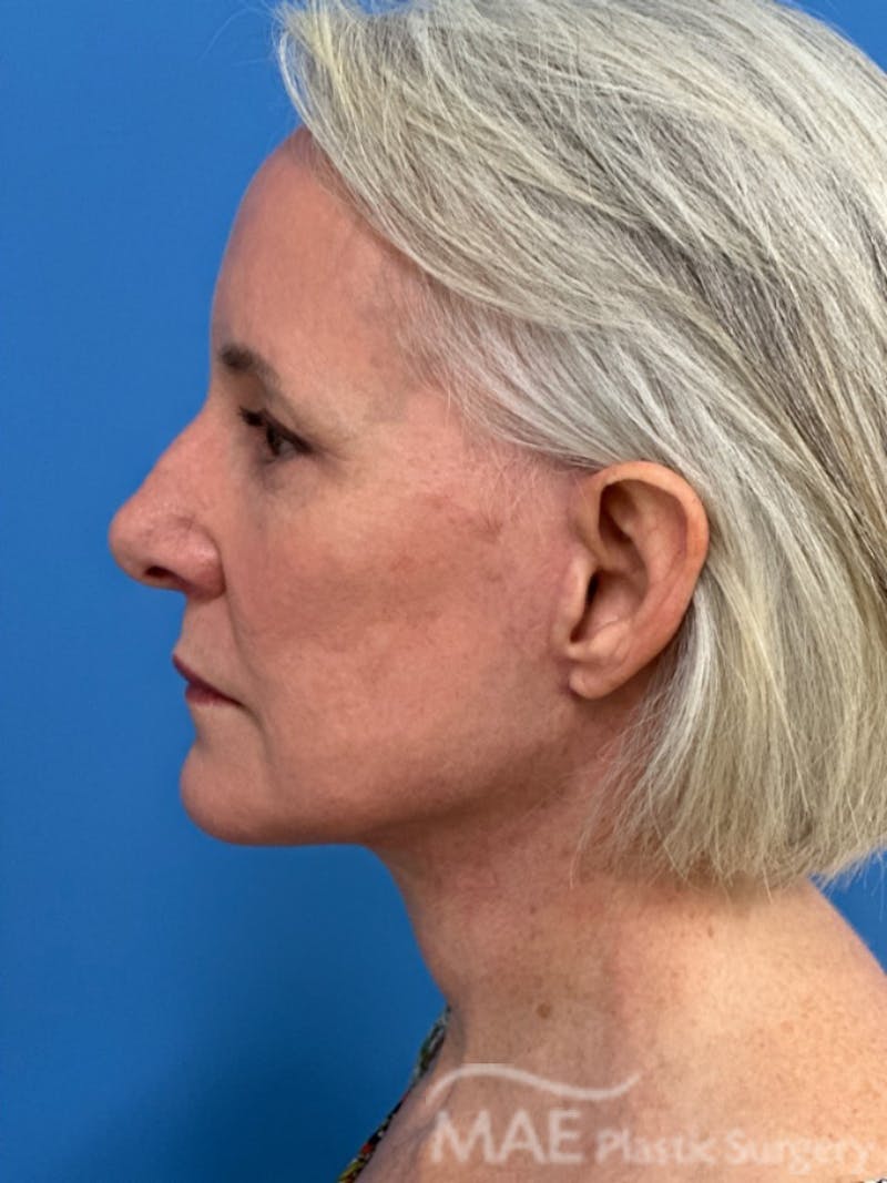 Facelift Before & After Gallery - Patient 278823 - Image 6