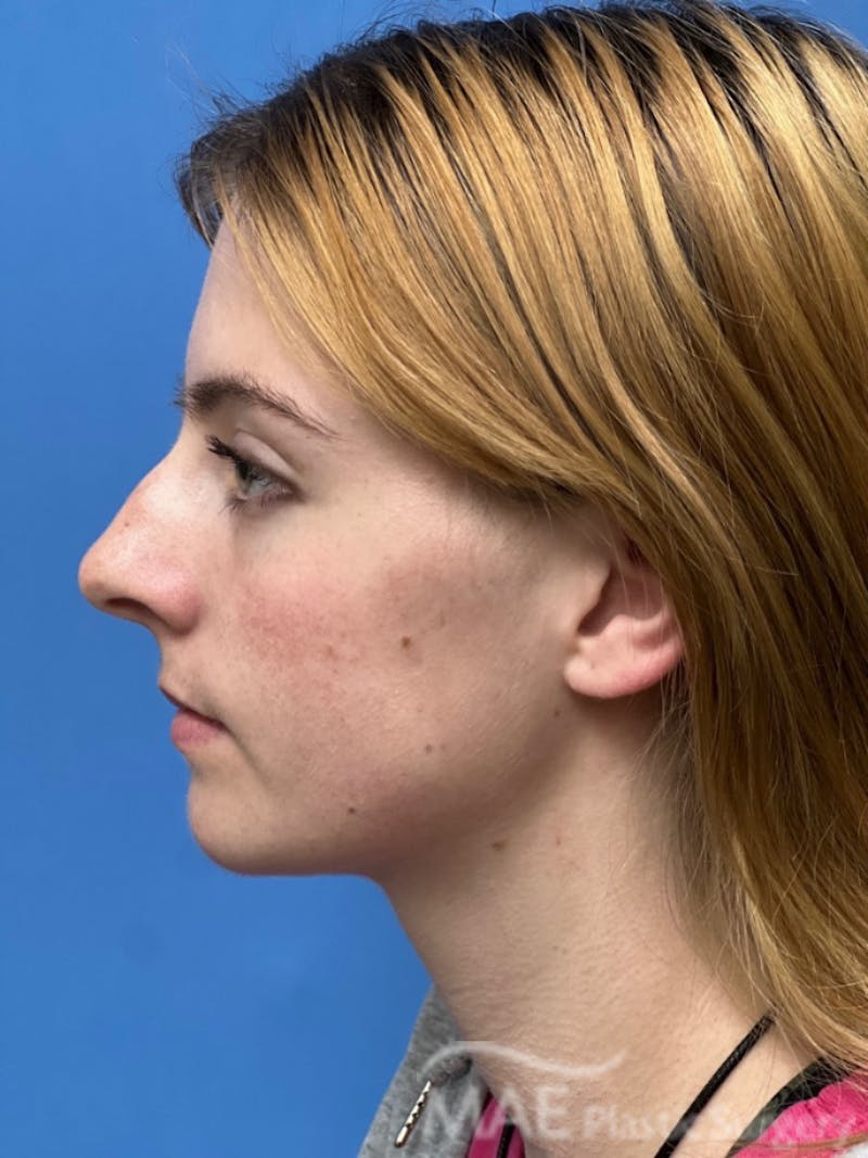 Rhinoplasty Before & After Gallery - Patient 145828 - Image 1