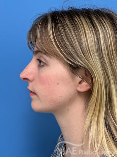 Rhinoplasty Before & After Gallery - Patient 145828 - Image 2