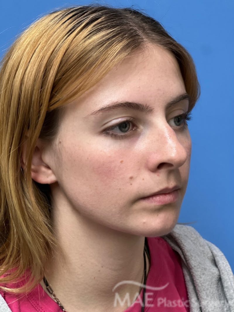 Rhinoplasty Before & After Gallery - Patient 145828 - Image 3
