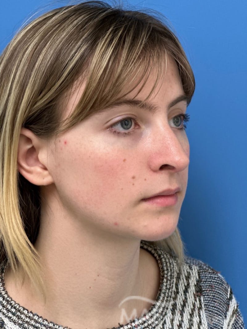 Rhinoplasty Before & After Gallery - Patient 145828 - Image 4