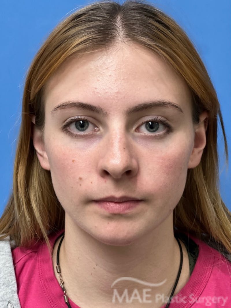 Rhinoplasty Before & After Gallery - Patient 145828 - Image 5