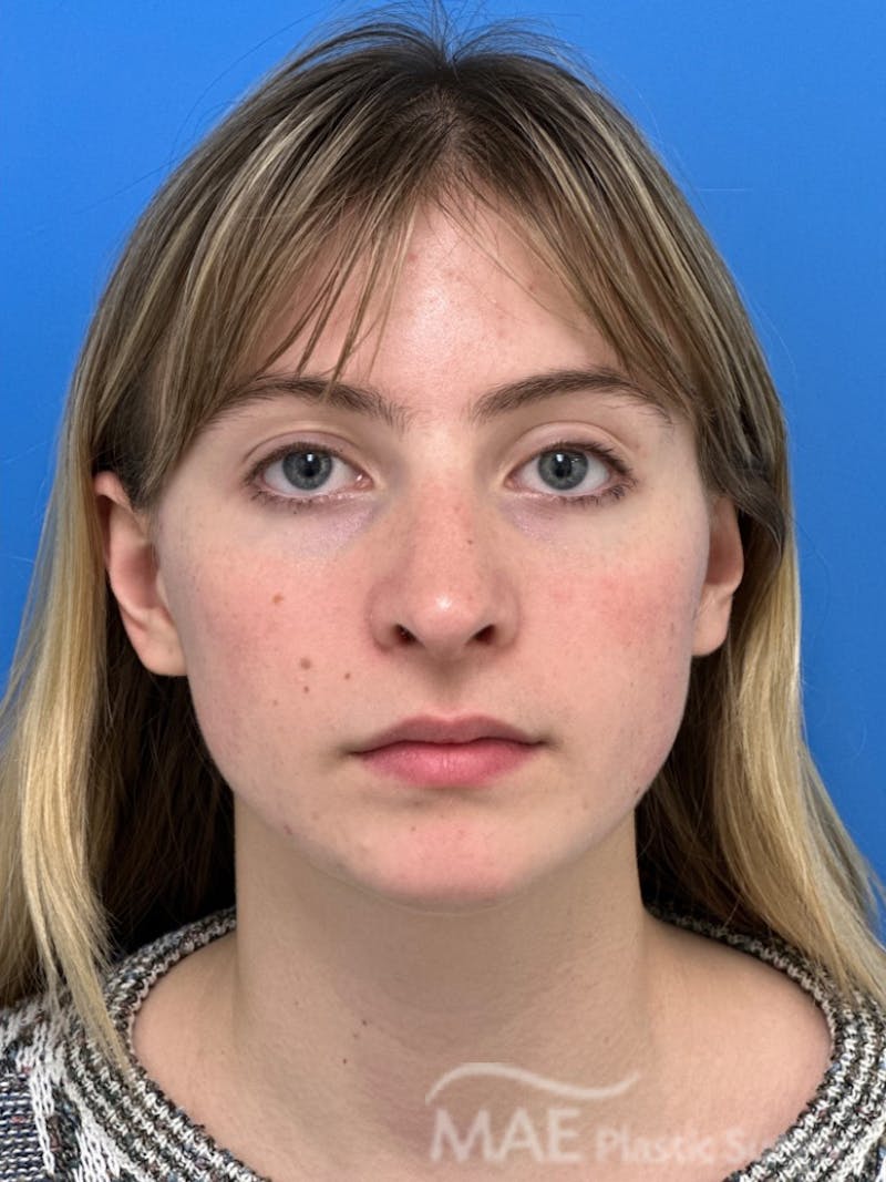 Rhinoplasty Before & After Gallery - Patient 145828 - Image 6
