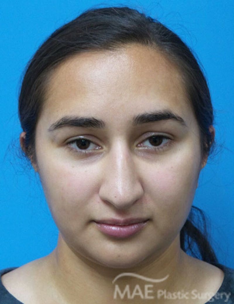 Rhinoplasty Before & After Gallery - Patient 361726 - Image 11