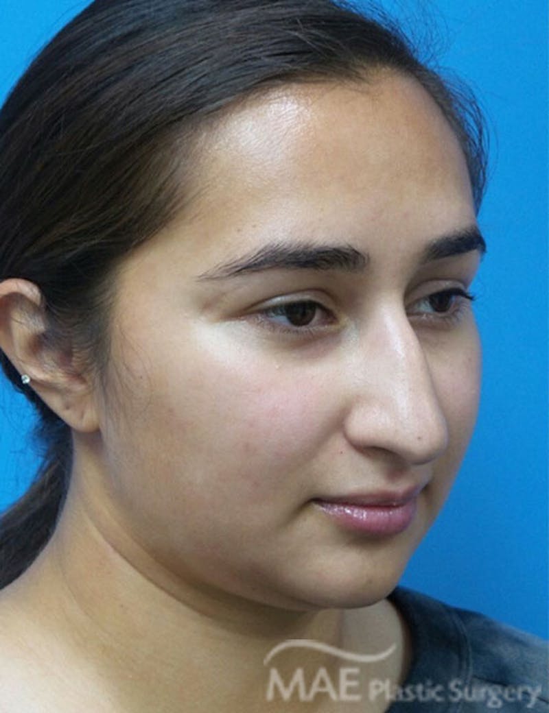 Rhinoplasty Before & After Gallery - Patient 361726 - Image 5