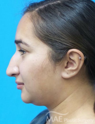 Rhinoplasty Before & After Gallery - Patient 361726 - Image 1