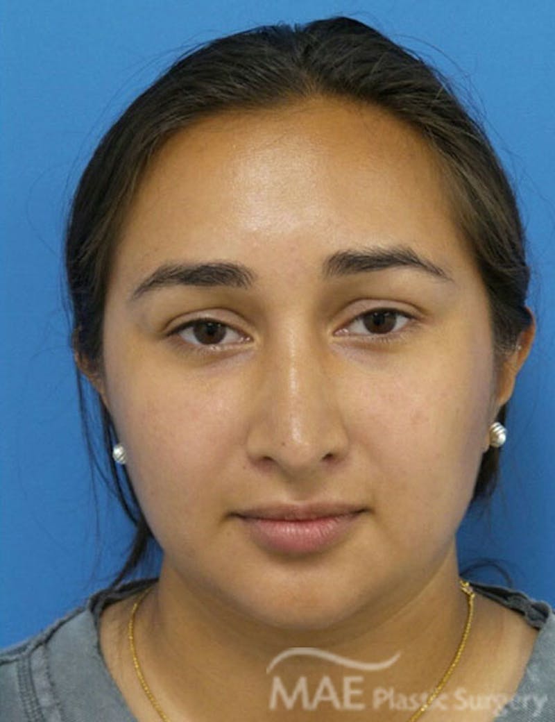 Rhinoplasty Before & After Gallery - Patient 361726 - Image 10