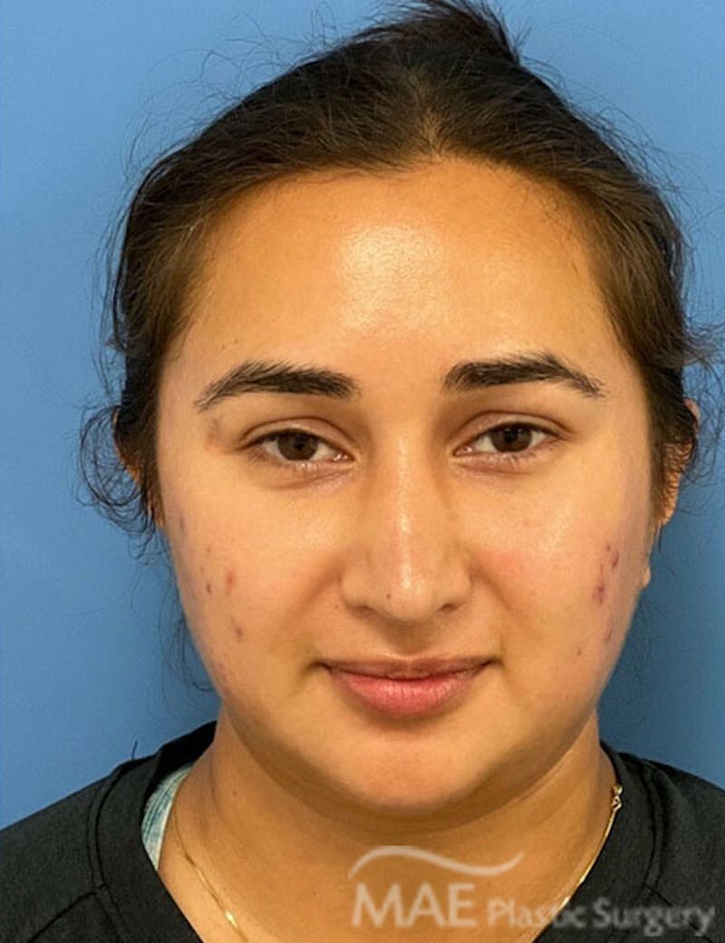 Rhinoplasty Before & After Gallery - Patient 361726 - Image 12