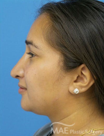 Rhinoplasty Before & After Gallery - Patient 361726 - Image 2