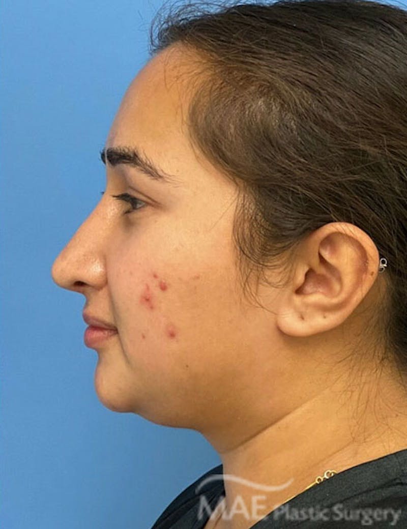 Rhinoplasty Before & After Gallery - Patient 361726 - Image 4