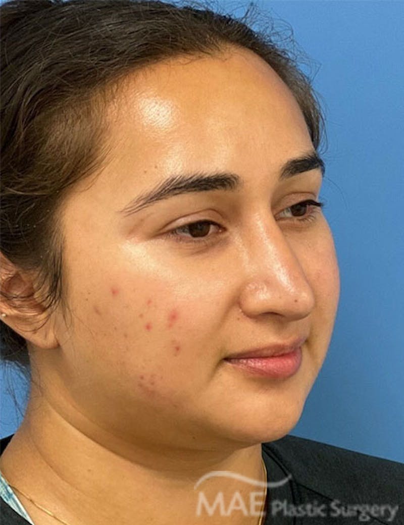 Rhinoplasty Before & After Gallery - Patient 361726 - Image 8