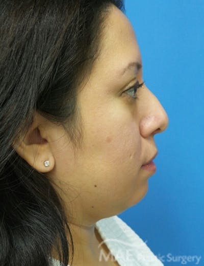 Rhinoplasty Before & After Gallery - Patient 321470 - Image 1