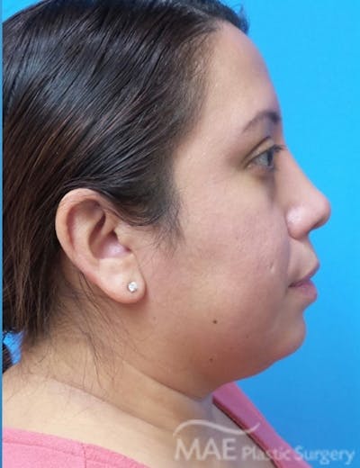 Rhinoplasty Before & After Gallery - Patient 321470 - Image 2