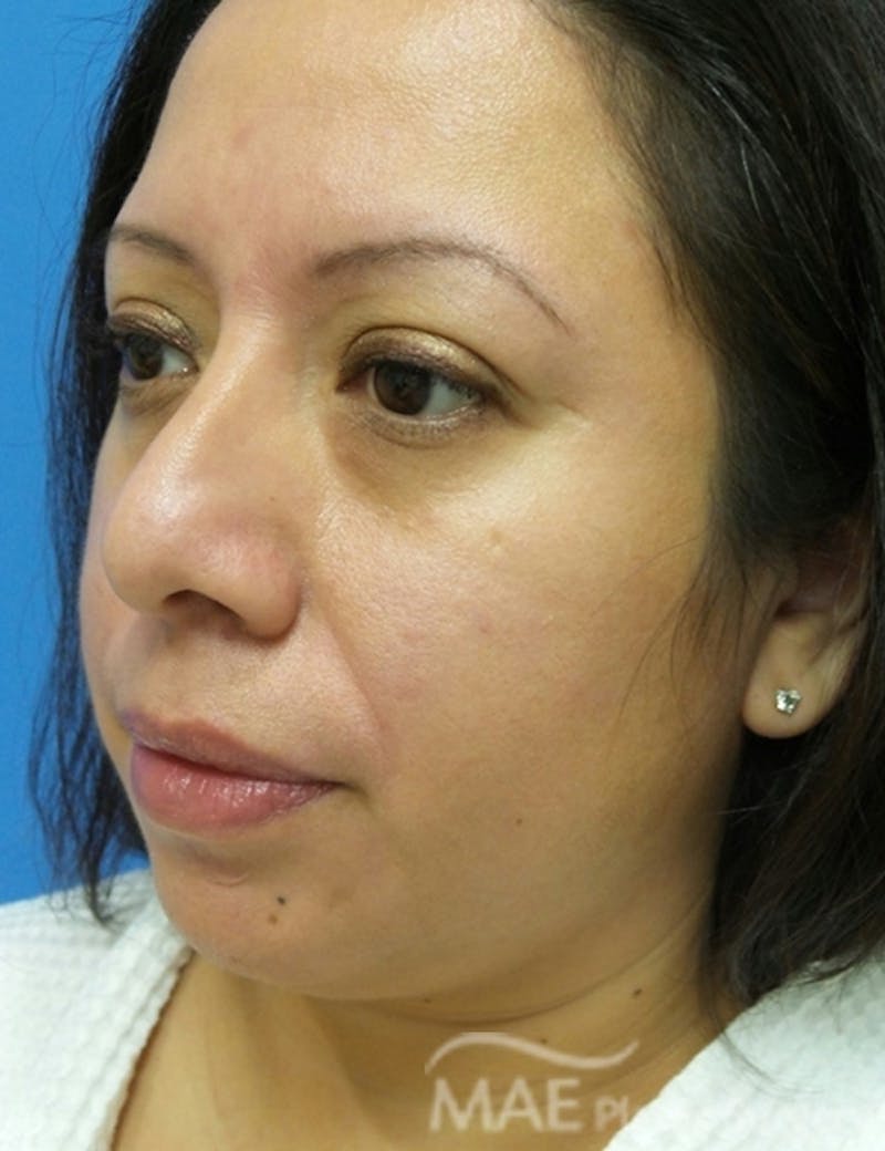 Rhinoplasty Before & After Gallery - Patient 321470 - Image 3