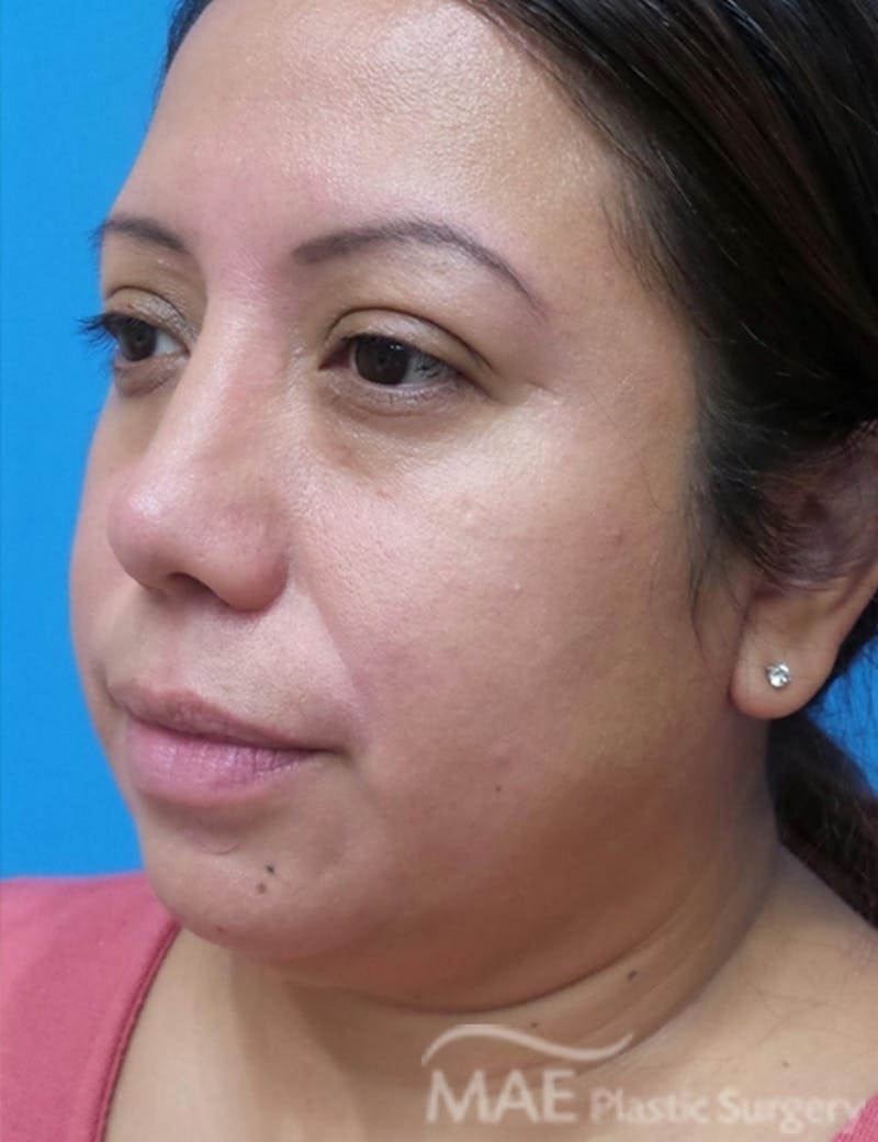 Rhinoplasty Before & After Gallery - Patient 321470 - Image 4