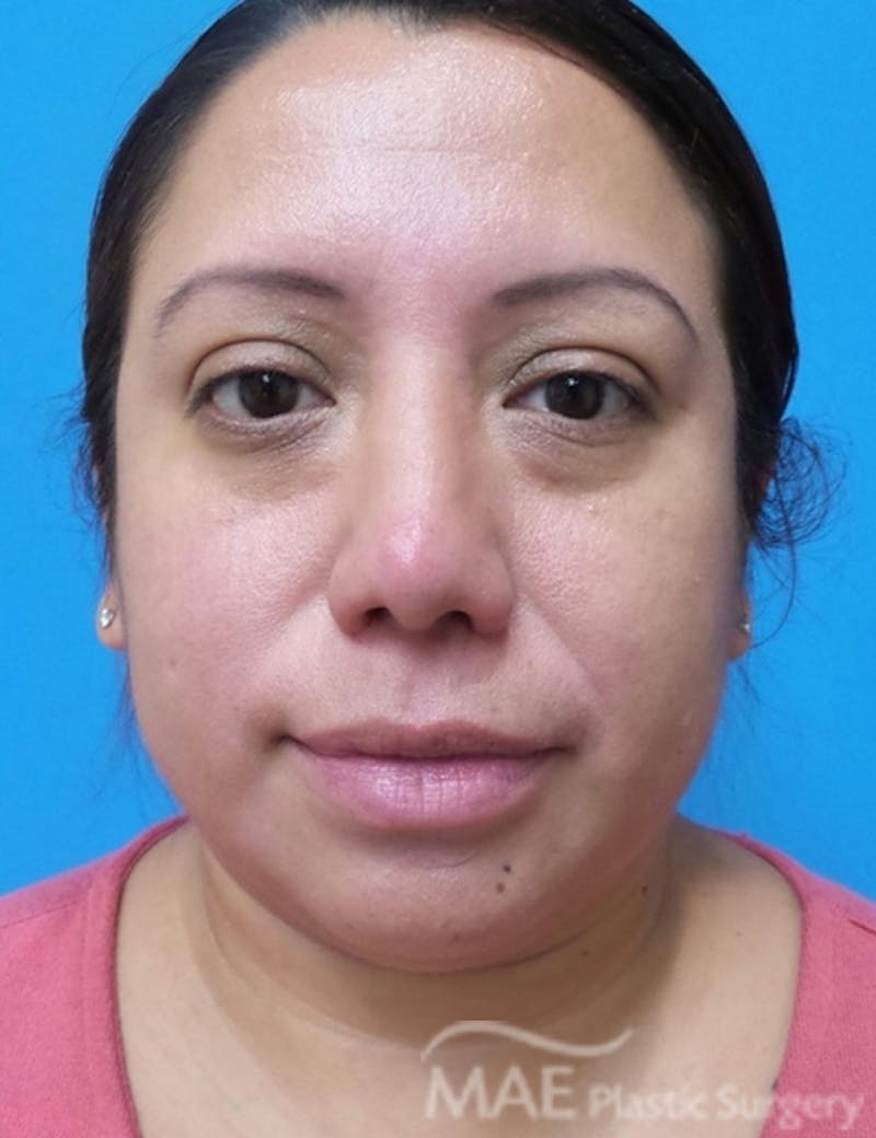 Rhinoplasty Before & After Gallery - Patient 321470 - Image 6