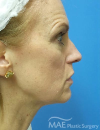 Rhinoplasty Before & After Gallery - Patient 122981 - Image 1