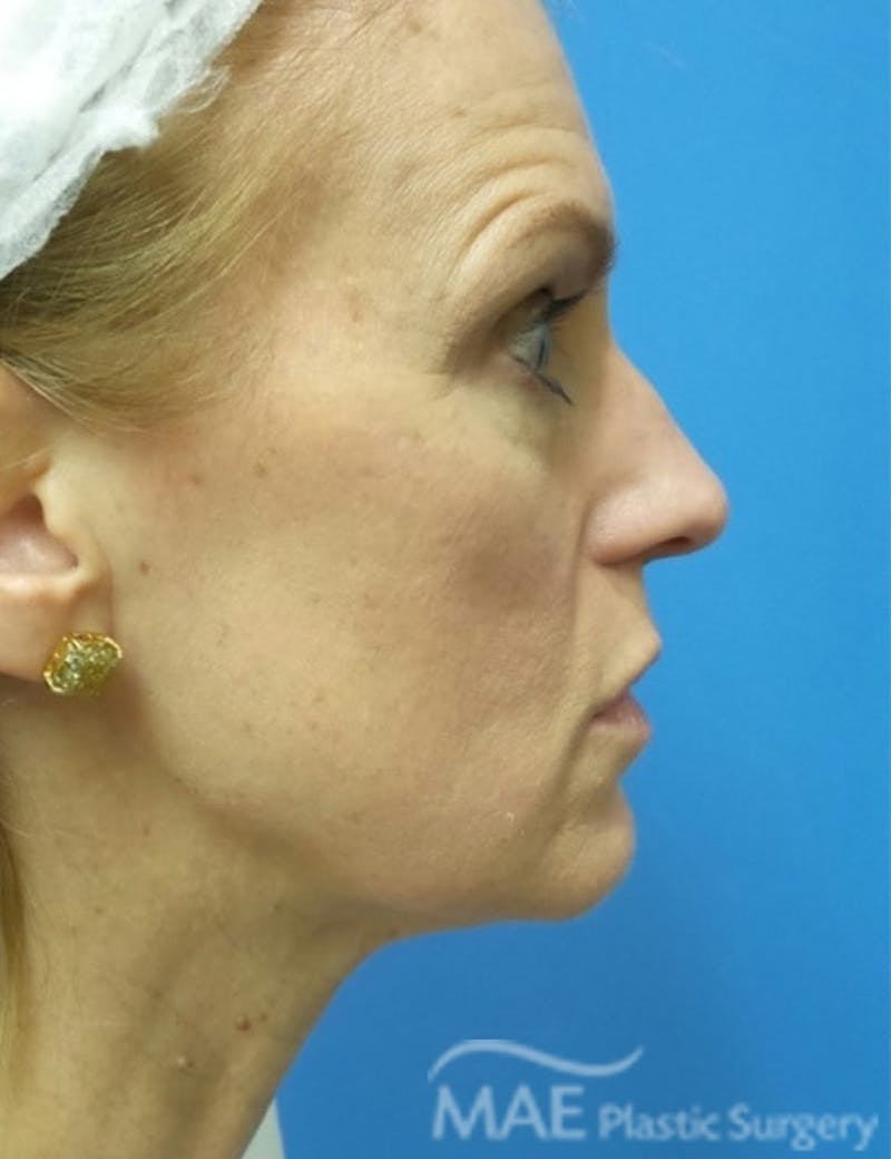 Rhinoplasty Before & After Gallery - Patient 122981 - Image 1