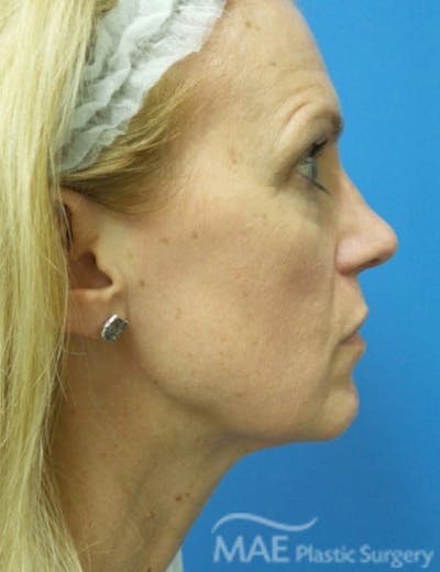 Rhinoplasty Before & After Gallery - Patient 122981 - Image 2