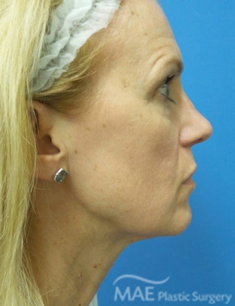 Rhinoplasty Before & After Gallery - Patient 122981 - Image 2