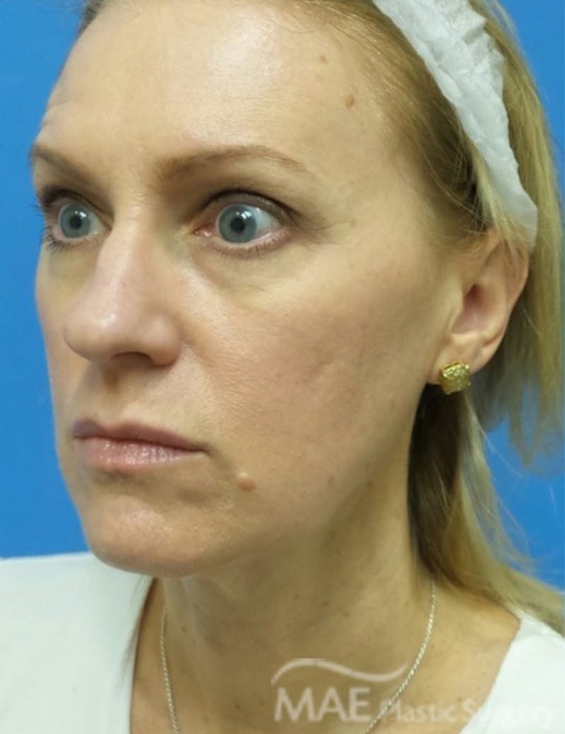 Rhinoplasty Before & After Gallery - Patient 122981 - Image 3