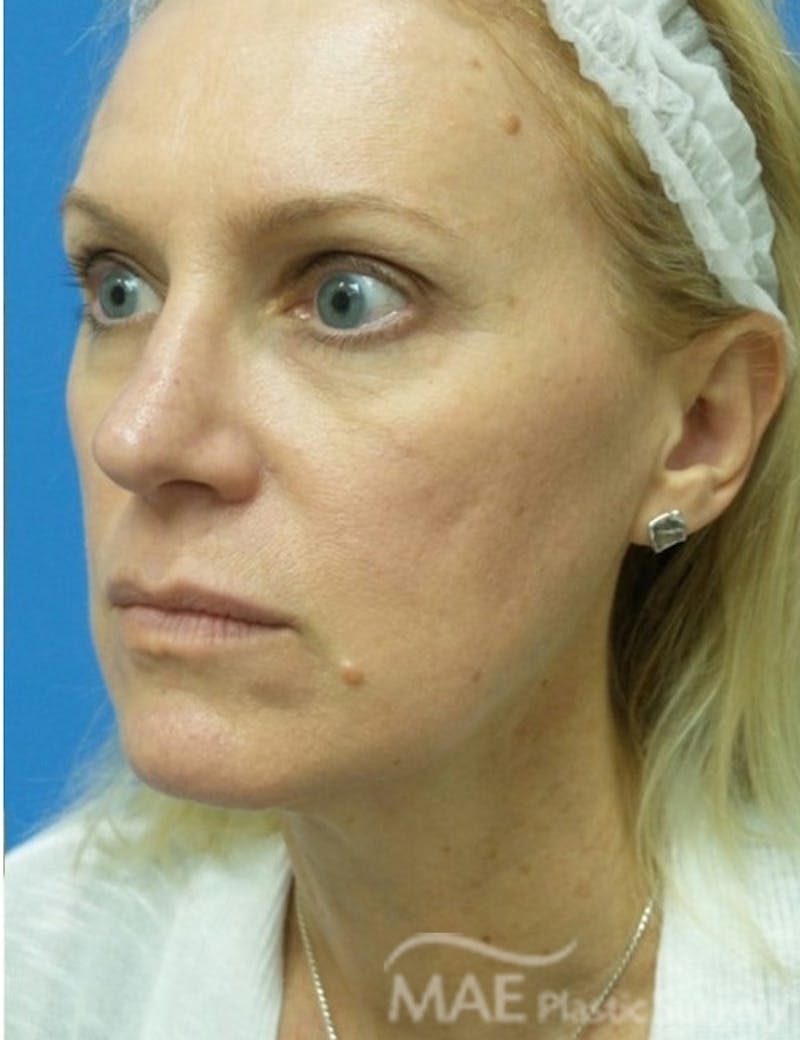 Rhinoplasty Before & After Gallery - Patient 122981 - Image 4