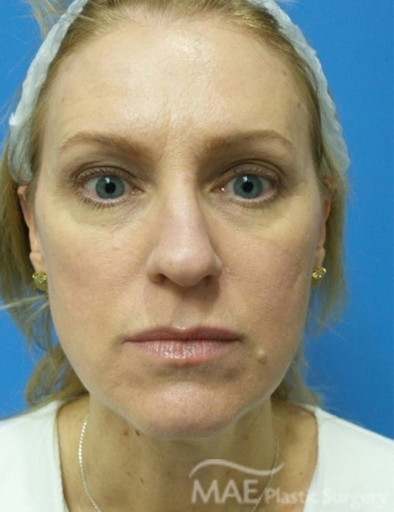 Rhinoplasty Before & After Gallery - Patient 122981 - Image 5
