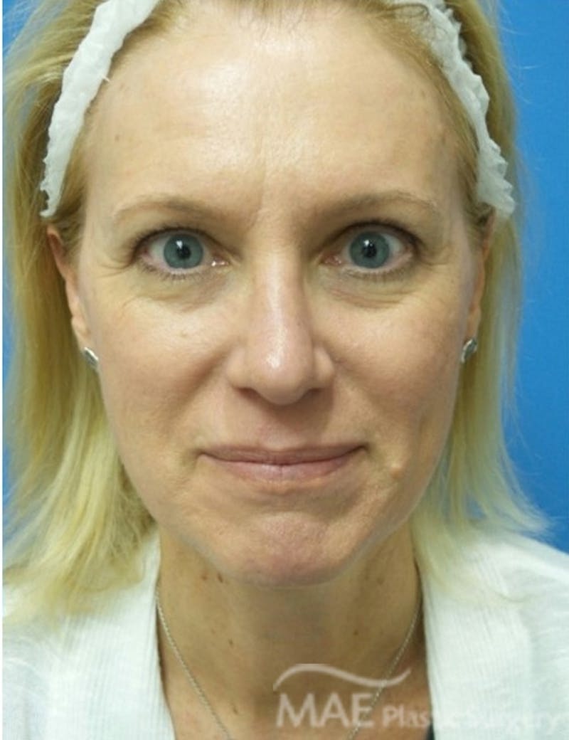 Rhinoplasty Before & After Gallery - Patient 122981 - Image 6