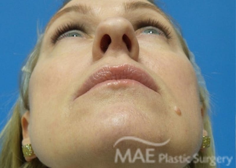 Rhinoplasty Before & After Gallery - Patient 122981 - Image 7
