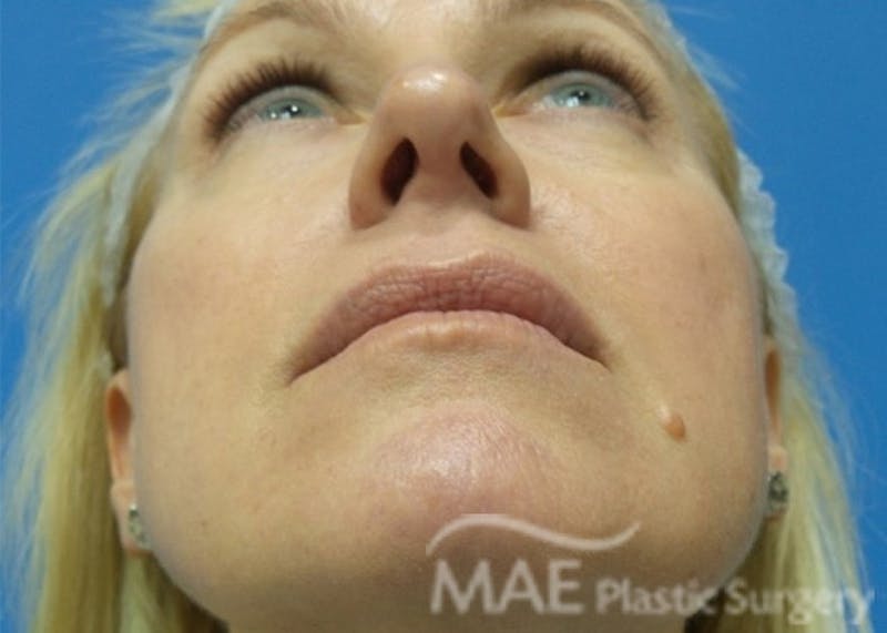 Rhinoplasty Before & After Gallery - Patient 122981 - Image 8