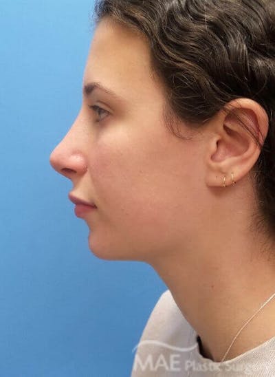 Rhinoplasty Before & After Gallery - Patient 233219 - Image 2