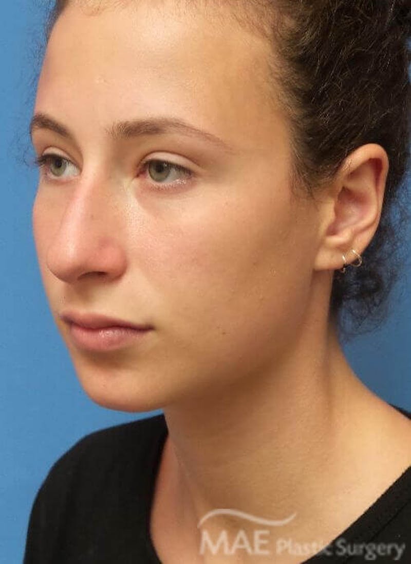 Rhinoplasty Before & After Gallery - Patient 233219 - Image 3