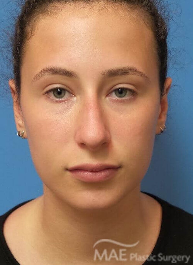 Rhinoplasty Before & After Gallery - Patient 233219 - Image 5