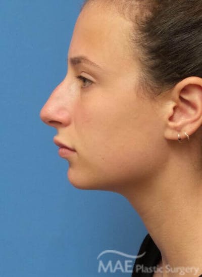 Rhinoplasty Before & After Gallery - Patient 233219 - Image 1