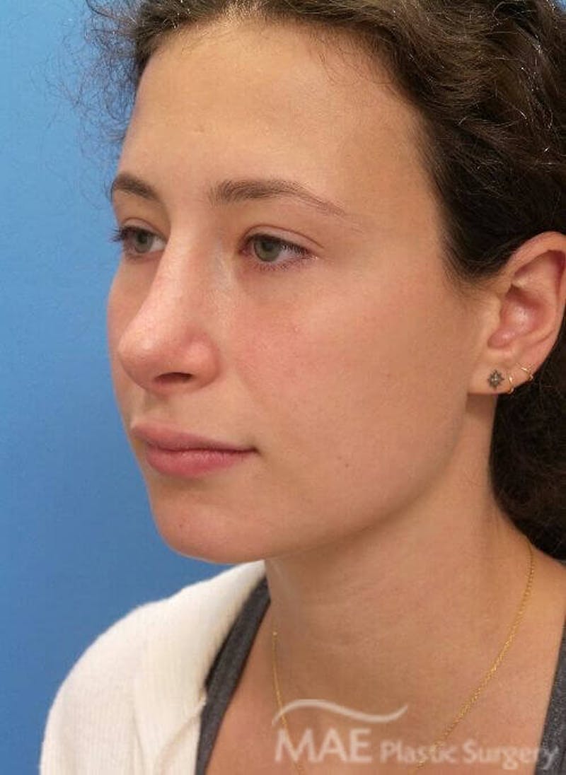 Rhinoplasty Before & After Gallery - Patient 233219 - Image 4