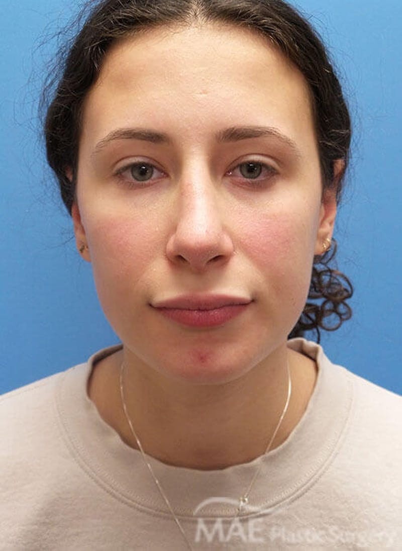 Rhinoplasty Before & After Gallery - Patient 233219 - Image 6