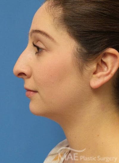 Rhinoplasty Before & After Gallery - Patient 136743 - Image 1