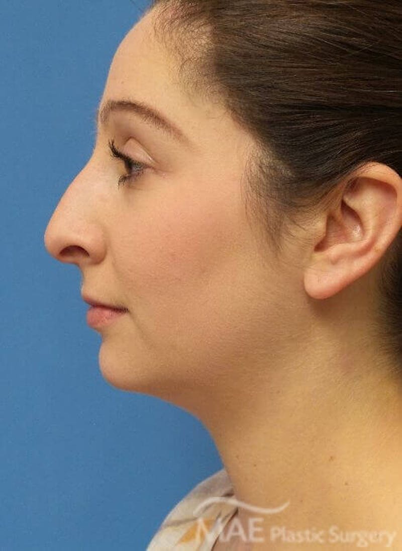 Rhinoplasty Before & After Gallery - Patient 136743 - Image 1