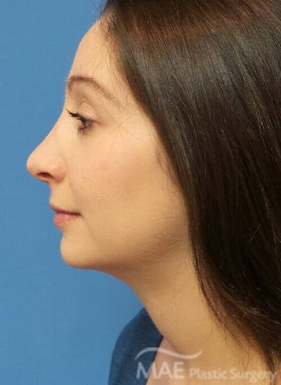 Rhinoplasty Before & After Gallery - Patient 136743 - Image 2