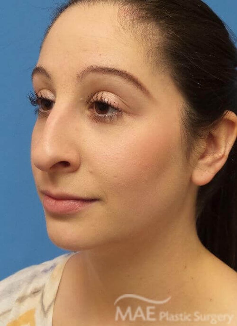 Rhinoplasty Before & After Gallery - Patient 136743 - Image 3