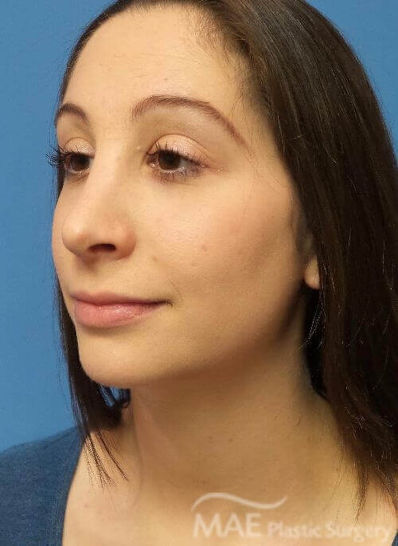 Rhinoplasty Before & After Gallery - Patient 136743 - Image 4