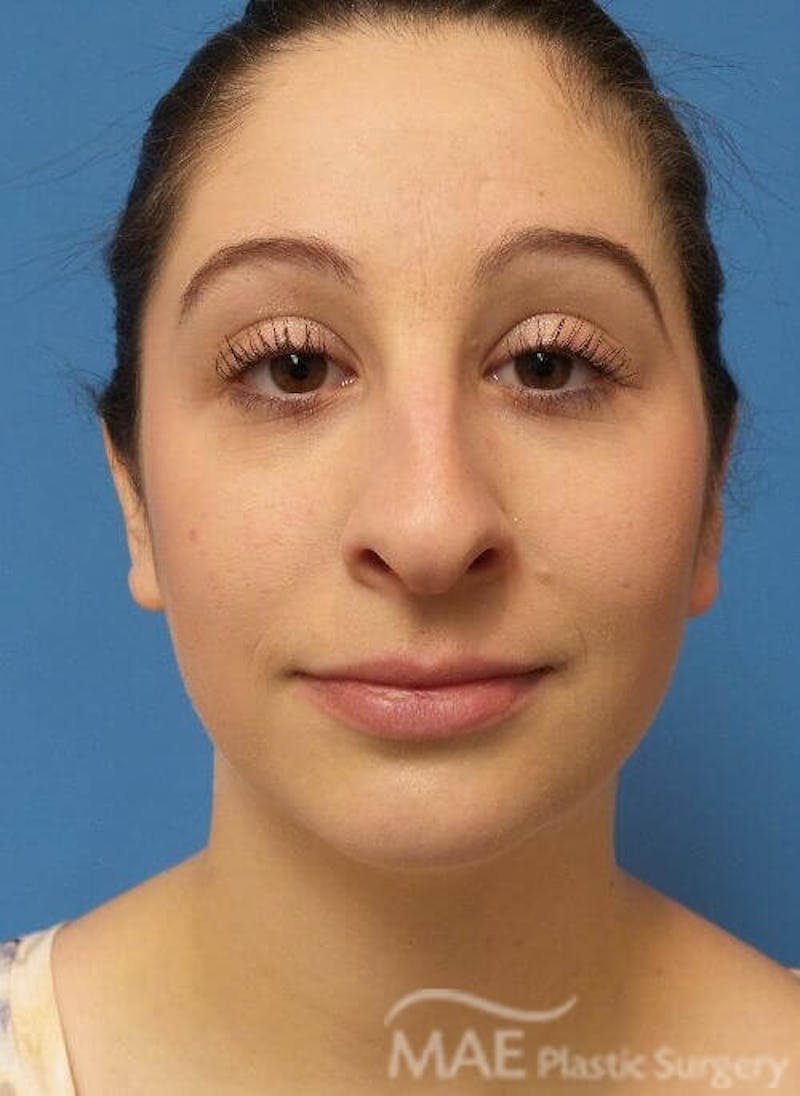 Rhinoplasty Before & After Gallery - Patient 136743 - Image 5