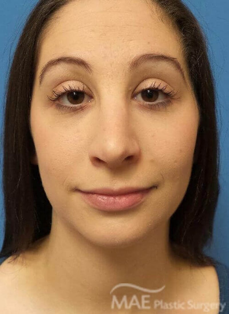 Rhinoplasty Before & After Gallery - Patient 136743 - Image 6