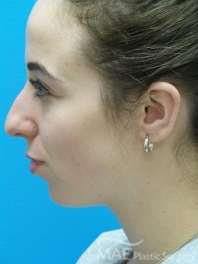 Rhinoplasty Before & After Gallery - Patient 278235 - Image 1